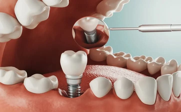 Dental Implant Timeline with Bone Graft: What to Expect