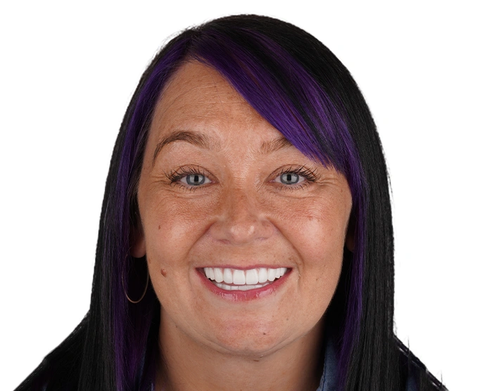 Liza N.: Veneers after