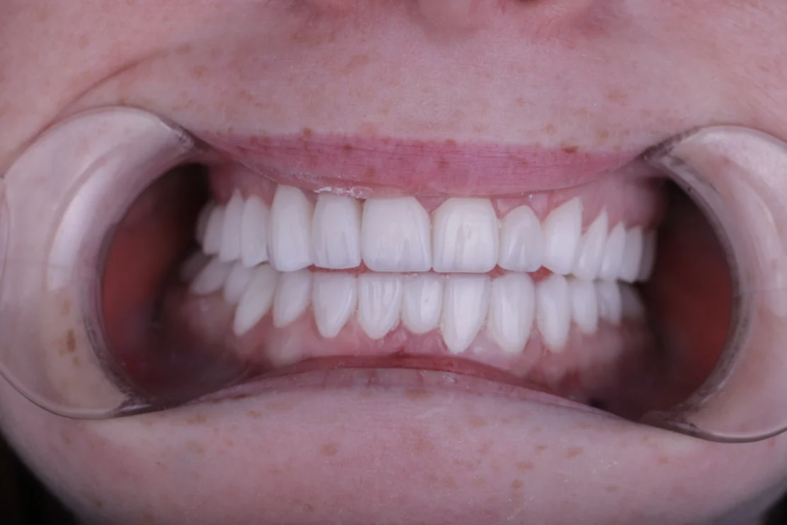Hollywood Smile: Custom veneers after