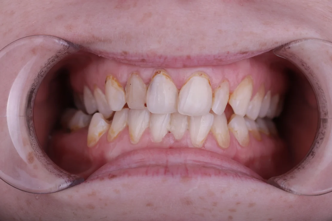 Hollywood Smile: Custom veneers before